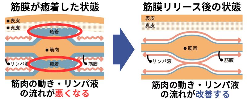 筋膜リリース前後の比較